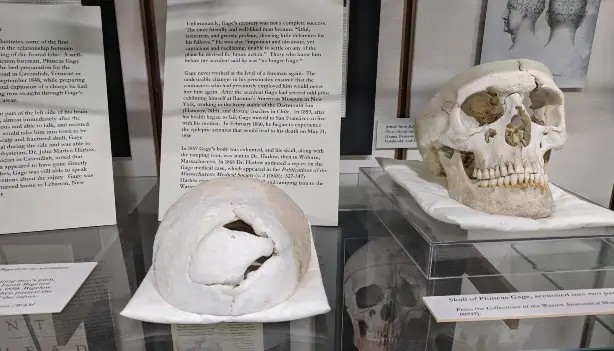 On display at harvard medical school the actual skull of Phineas gage showing entry and exit point of the iron rod