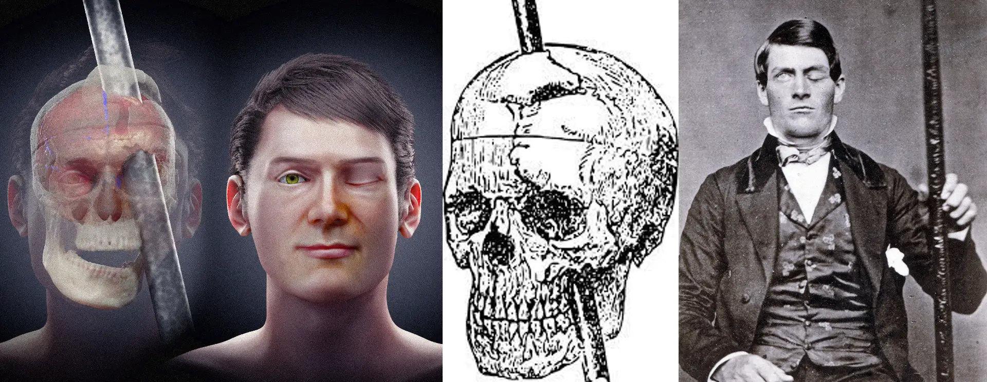 A diagram of A skull and metal rod displayed together, illustrating the extraordinary case of Phineas Gage and his miraculous recovery from a tragic accident.